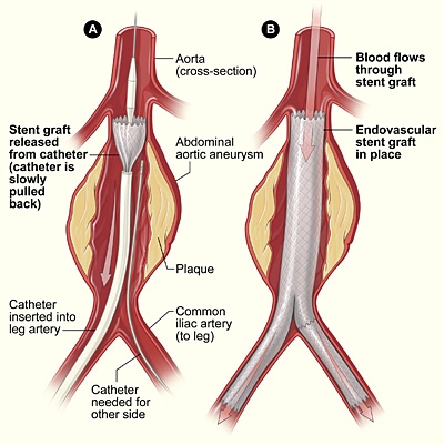 poza despre anevrismul aortic abdominal